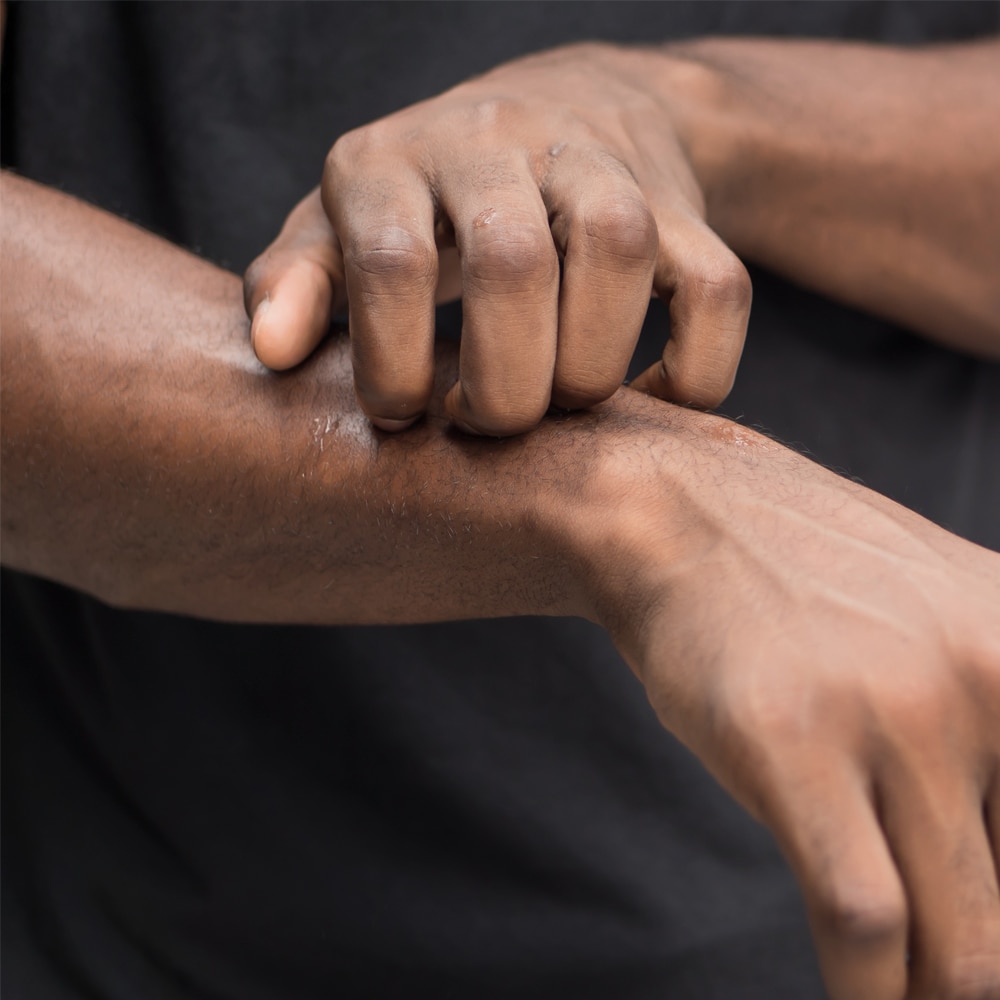 Remedies for Itching In Winter Unilever Vaseline®