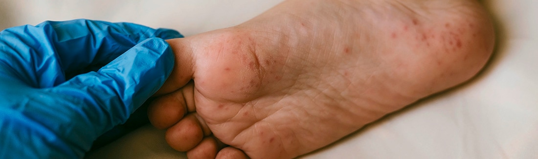 Cách phòng bệnh tay chân miệng cho trẻ