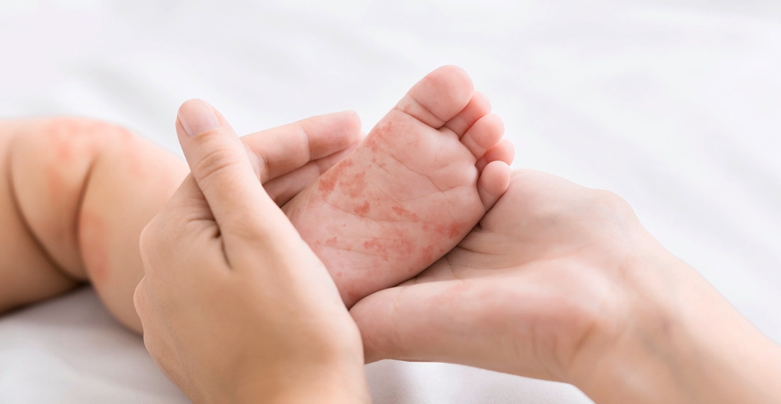 Bệnh sởi thường xuất hiện nhiều ở trẻ nhỏ khi chưa tiêm đủ các mũi vắc-xin