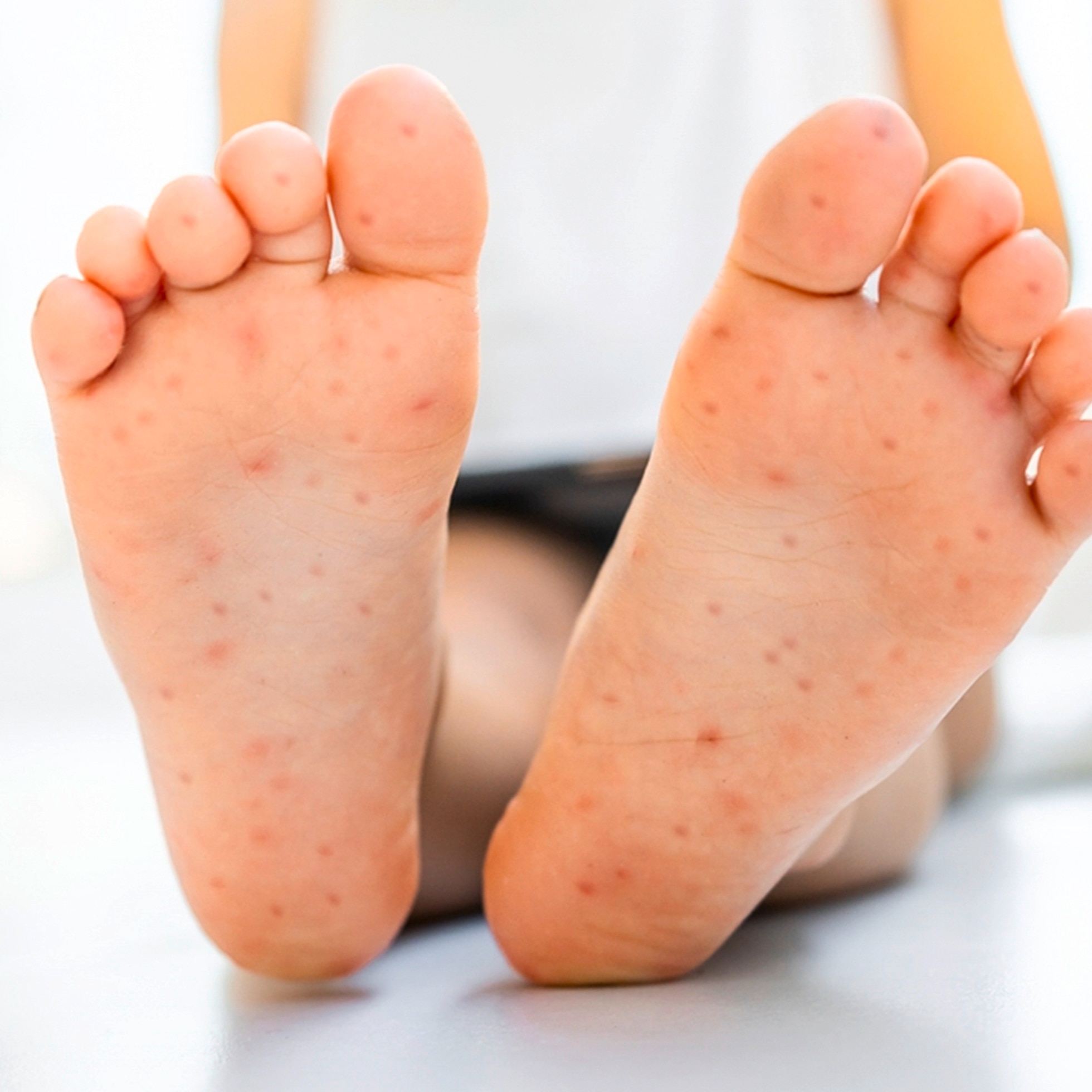 Bệnh tay chân miệng cấp độ 1 & Cách điều trị