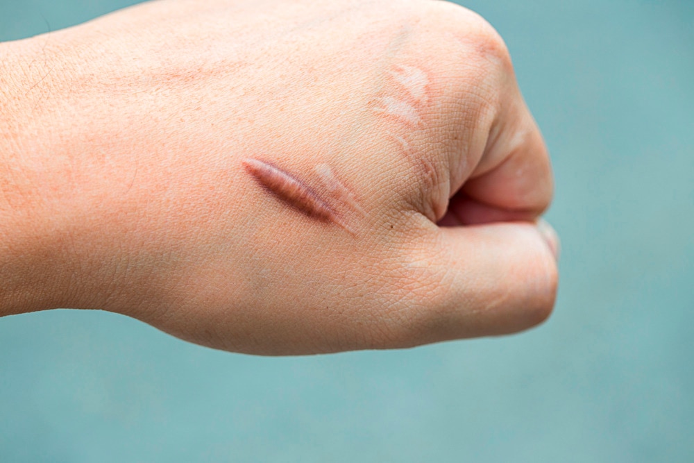 Raised scar on a person’s hand.