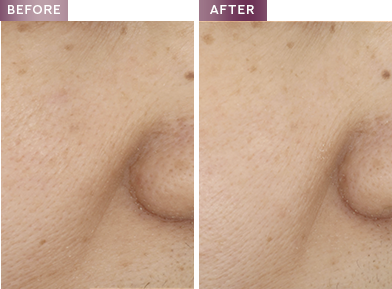 hexyl-retinol™: a superior ingredient