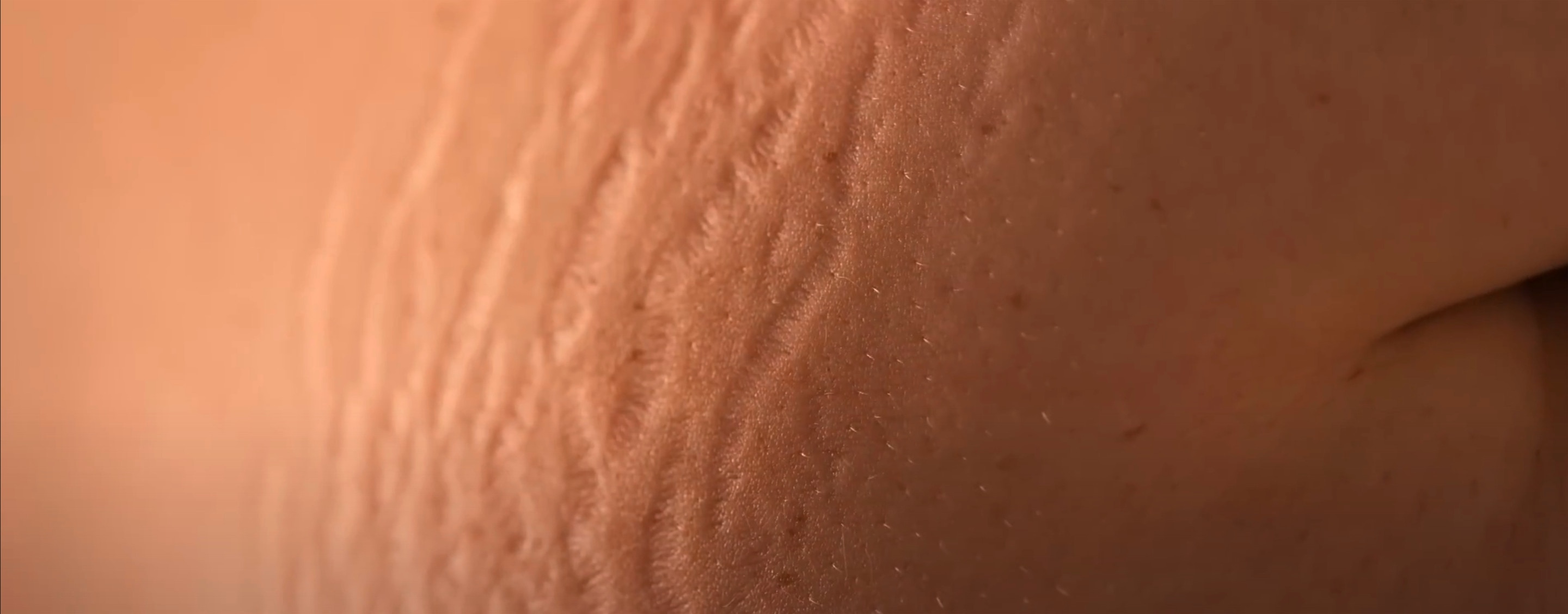 Stretch marks on a stomach