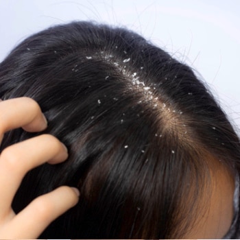 Apakah Ketombe Boleh Digaruk