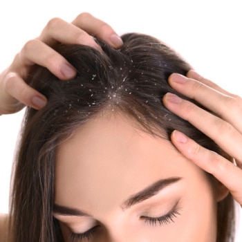 Apakah Ketombe itu Hidup