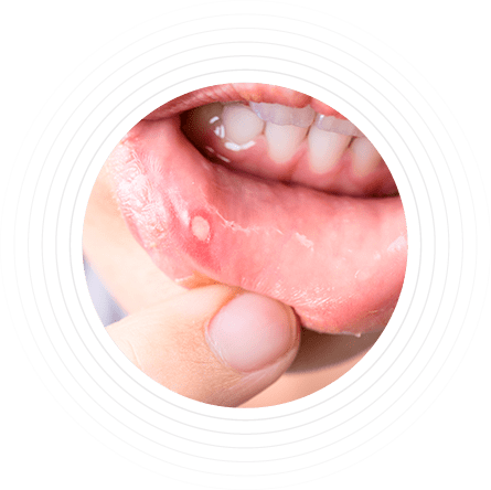 Mucosa oral sensible
