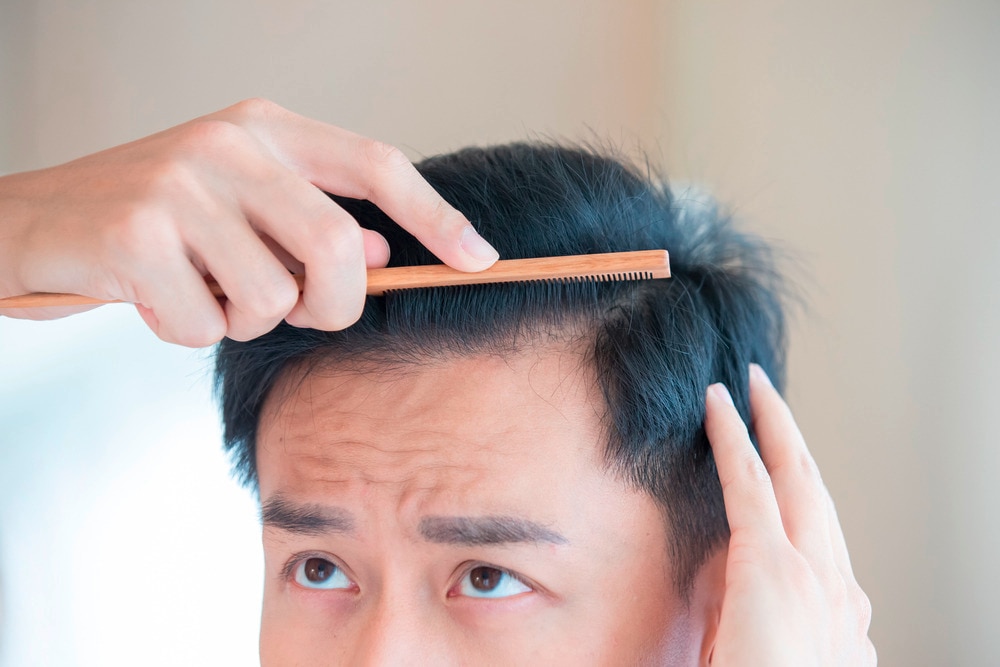 Can Severe Dandruff Lead to Hair Loss?