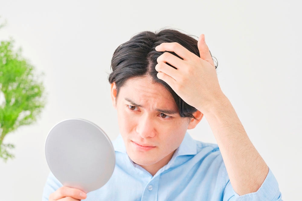 Man checking his severe dandruff with a handheld mirror.