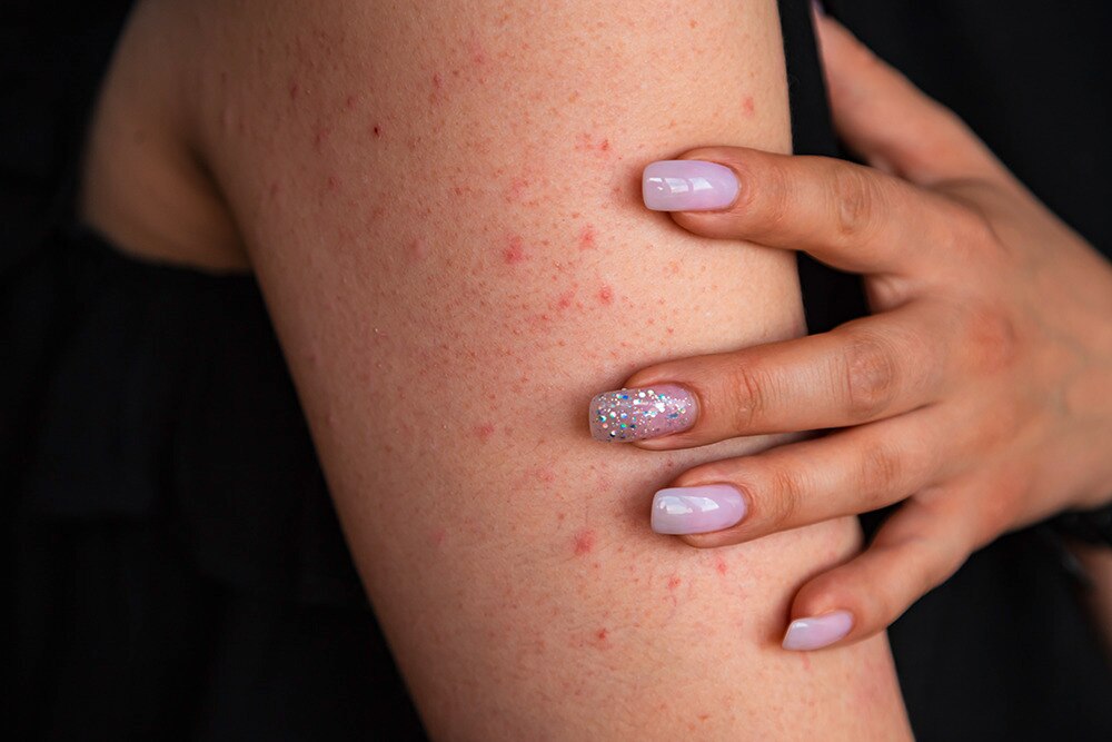 A portrait of woman with keratosis pilaris on her arm.