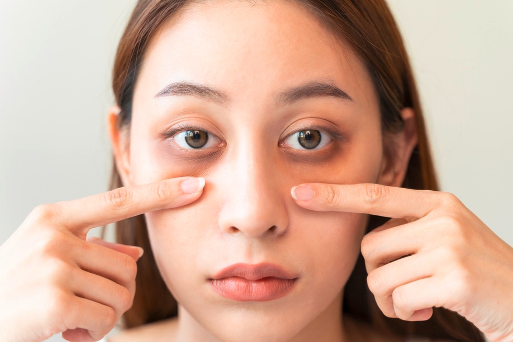 Young Asian woman pointing at dark circles under her eyes.