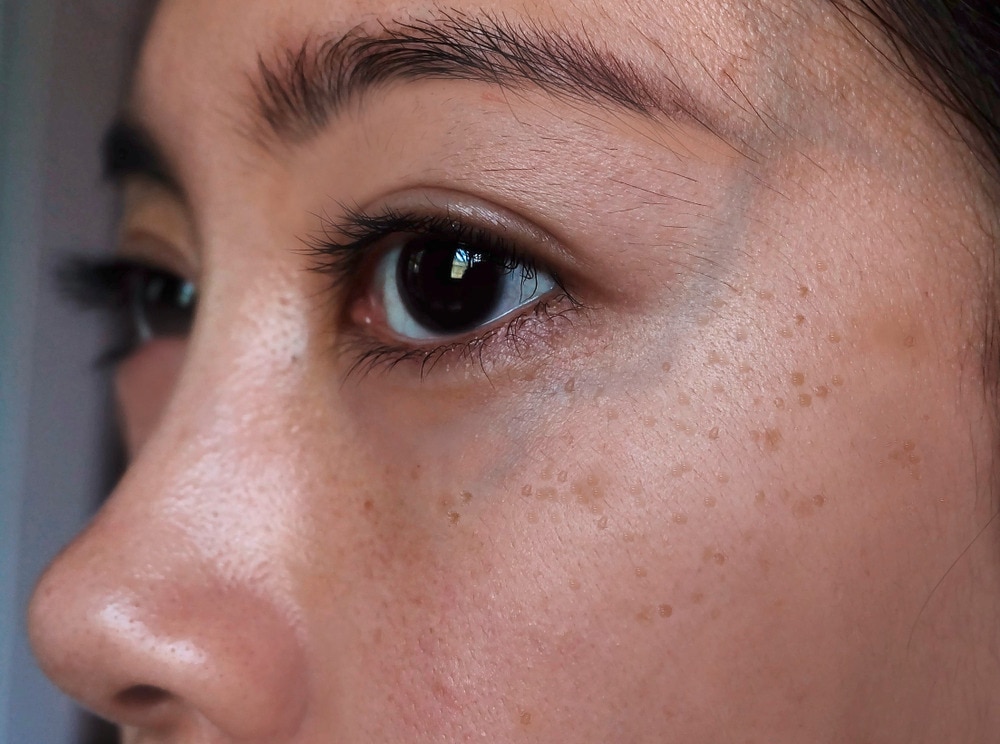 Closeup of hyperpigmentation on an Asian woman’s face.