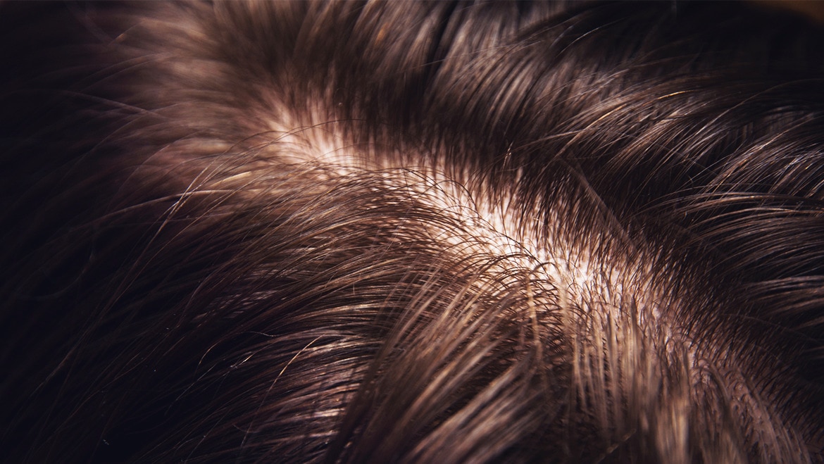 What causes dandruff? - Dry Scalp Text