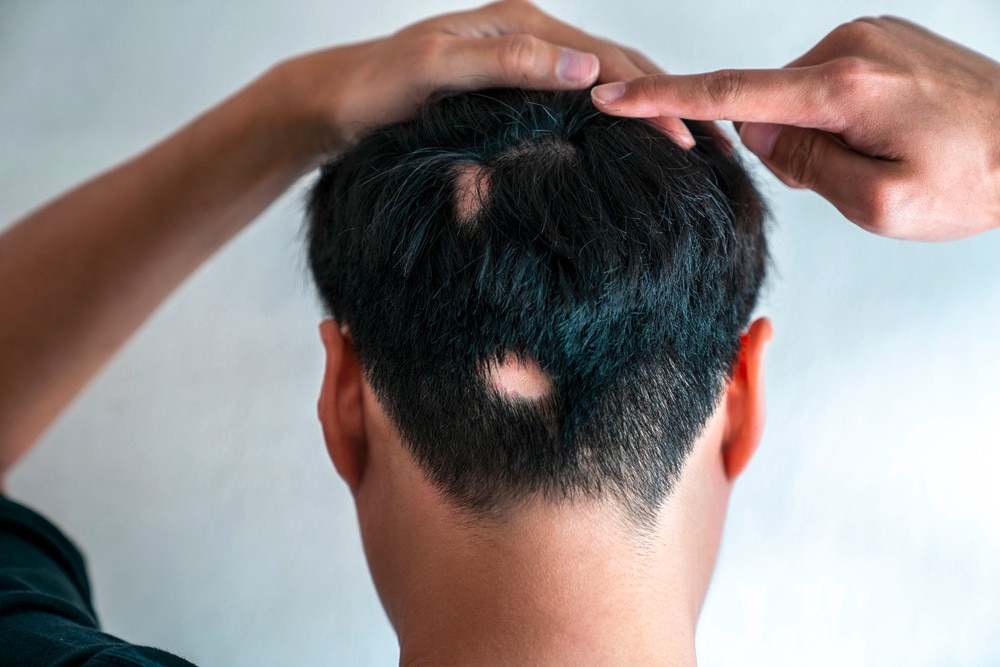 Man pointing at his bald spot on his head.