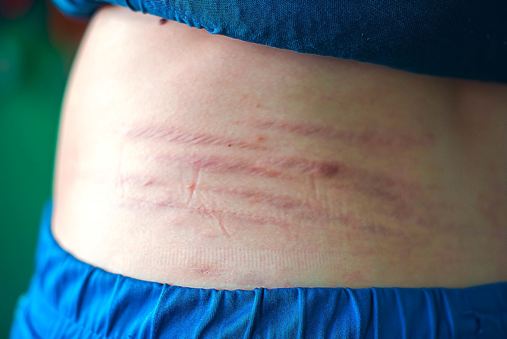 A portrait of red stretch marks on a person’s back.