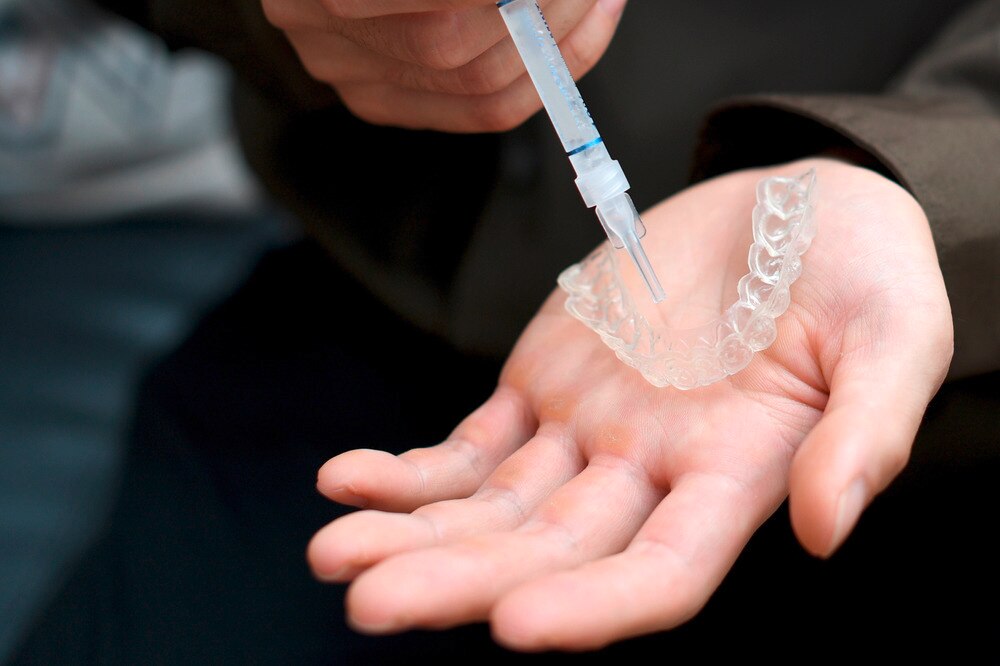Man applying teeth whitening gel onto his invisible aligner.