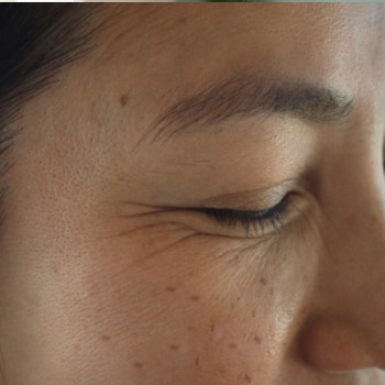 cara mengatasi garis halus dibawah mata