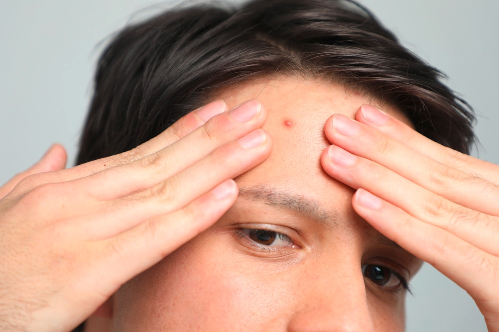 Asian man with a pimple on his forehead.