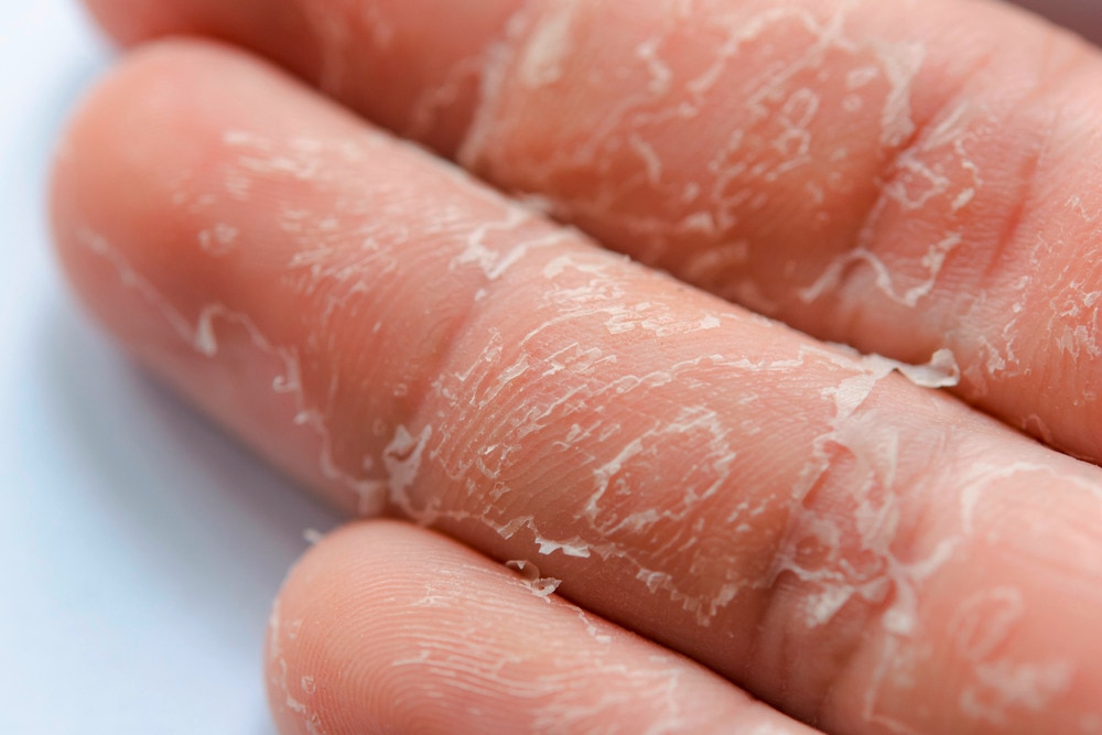 Closeup of flaky skin on fingers.