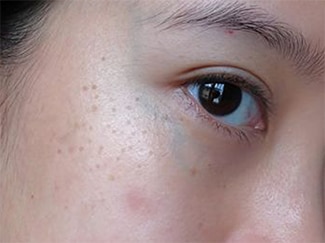 7 Cara Memilih Skincare untuk Menghilangkan Bekas Jerawat