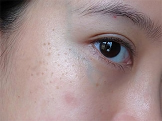 17 Penyebab dan Cara Menghilangkan Bekas Jerawat Hitam