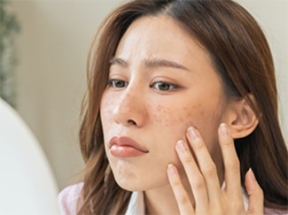 10 Penyebab Bintik Hitam Di Kulit Wajah yang Harus Kamu Ketahui