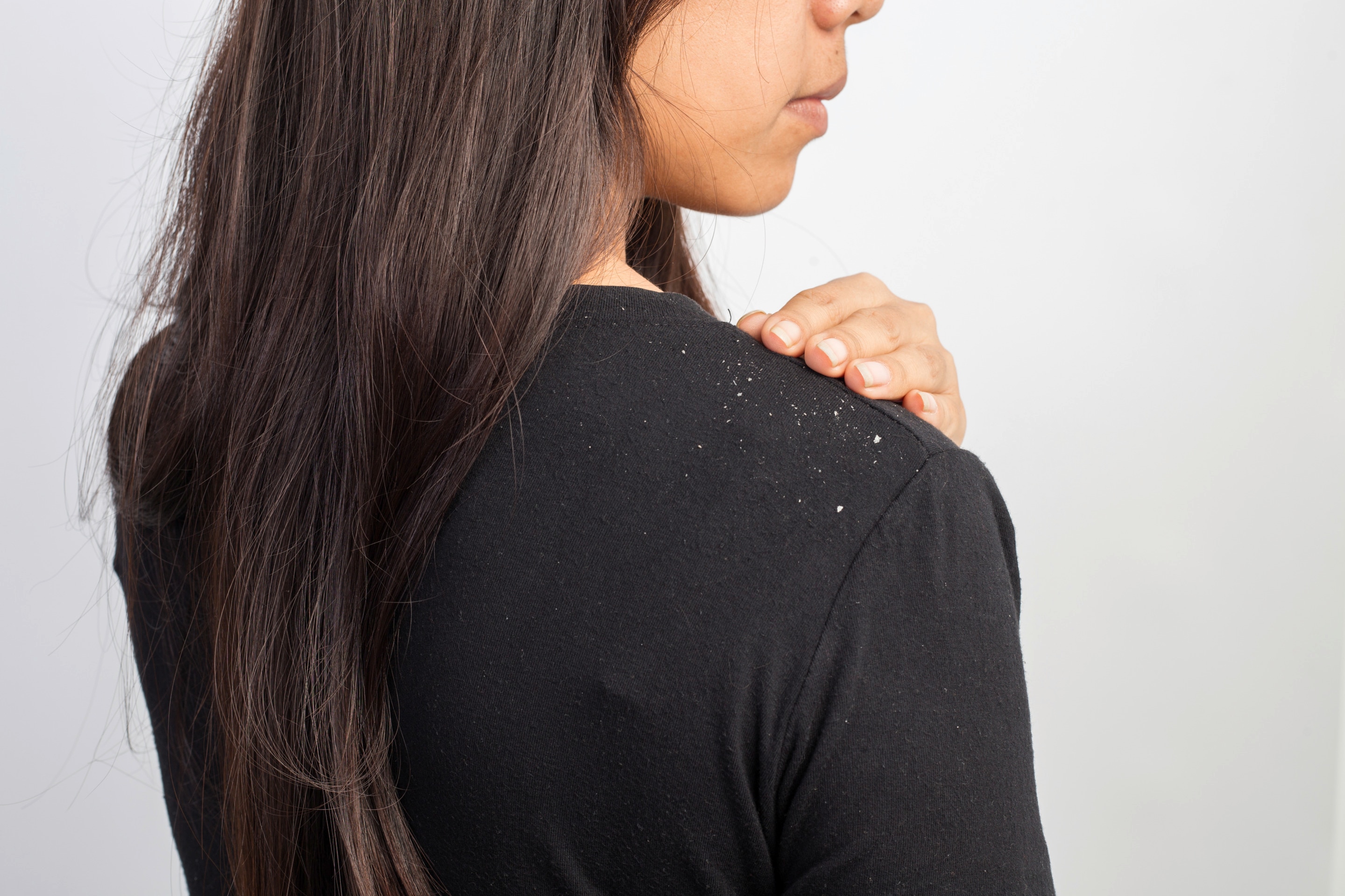 Woman with dandruff on her shoulder