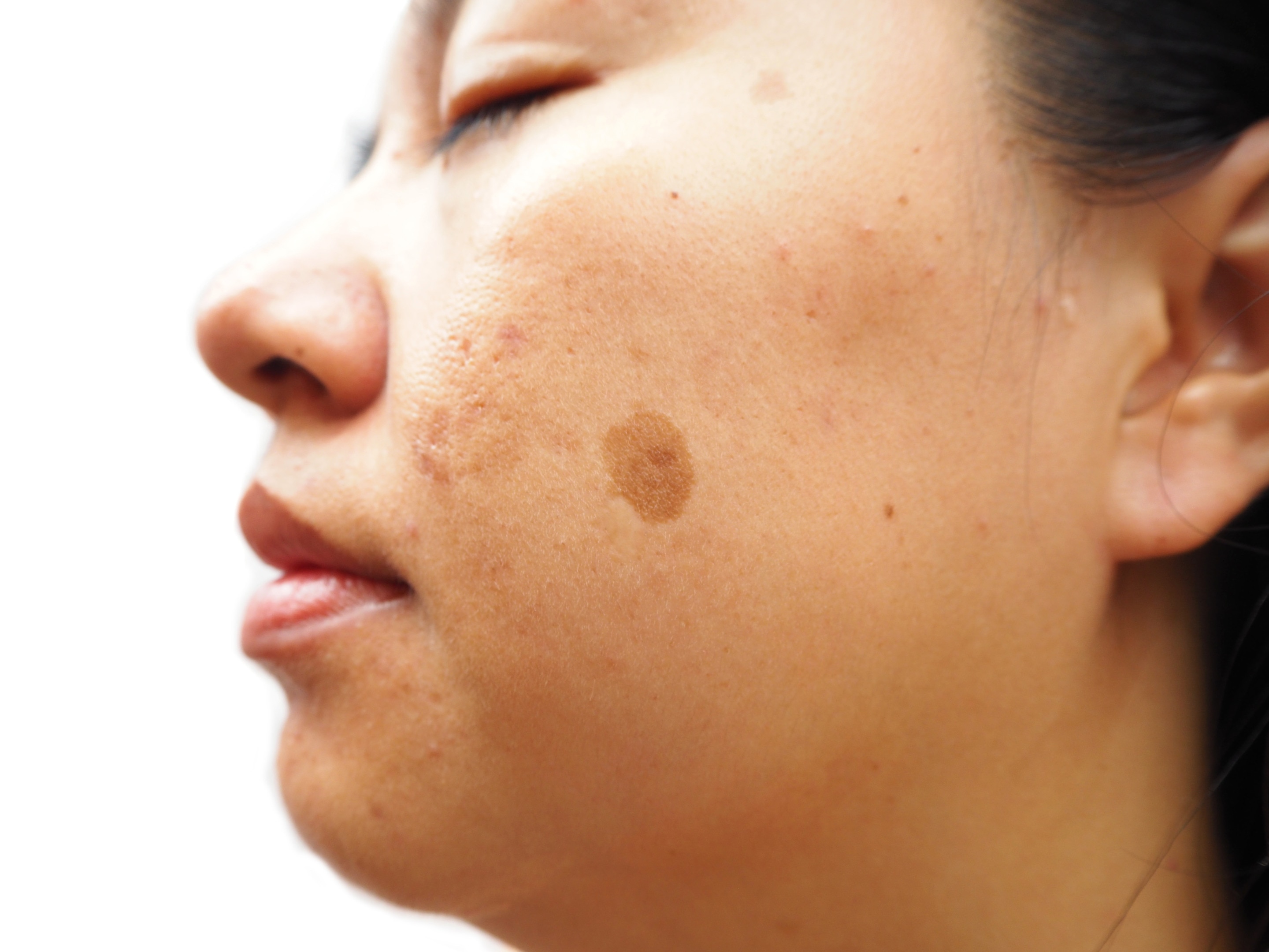 Woman with melasma on cheek