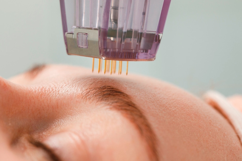 A closeup of microneedling tool hovering over a woman’s face.
