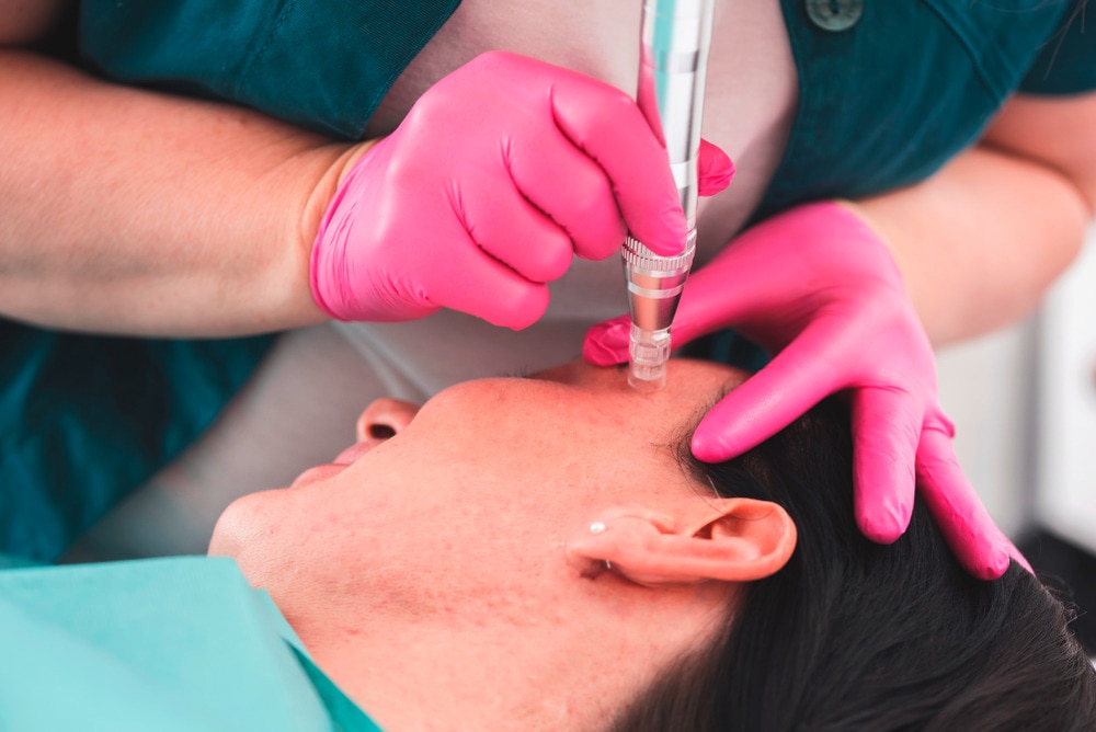 A portrait of dermatologist microneedling a patient’s face.