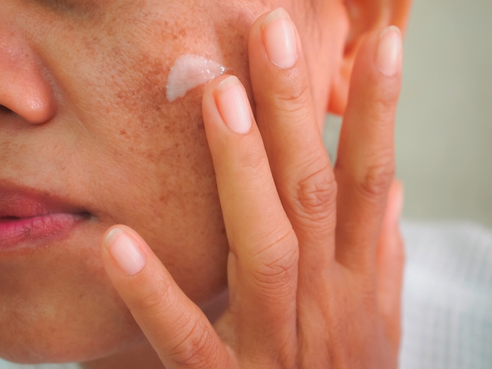 Woman applying cream to treat her age spots.