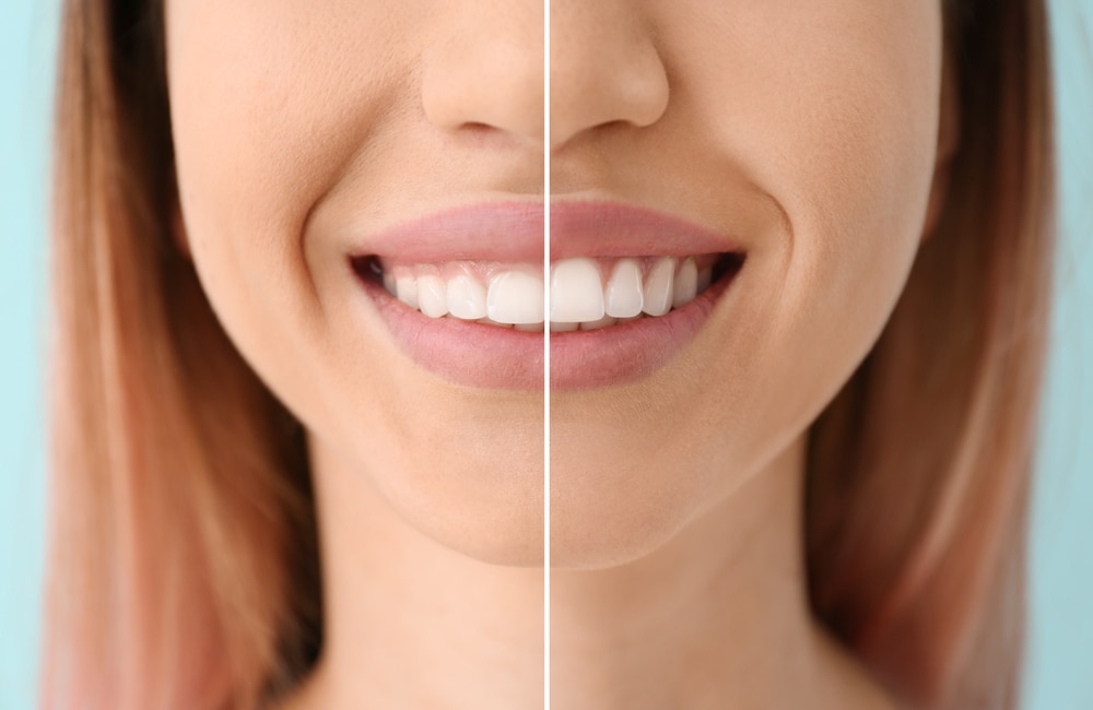 Gummy smile adalah