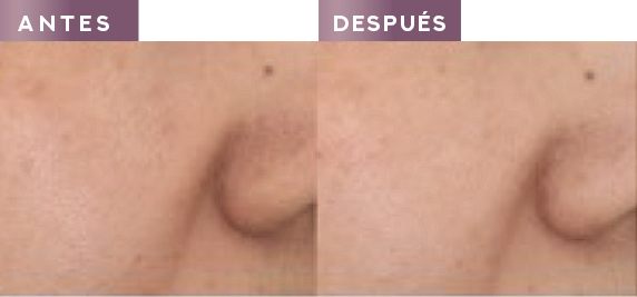 hexyl-retinol™: a superior ingredient