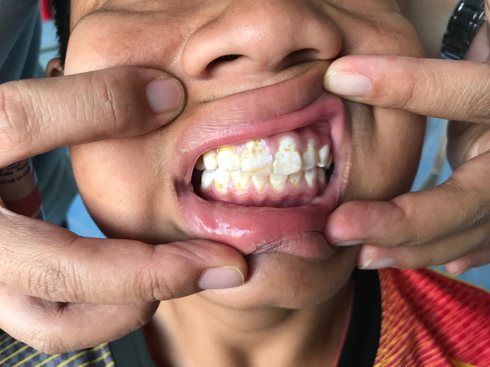 fluorosis gigi