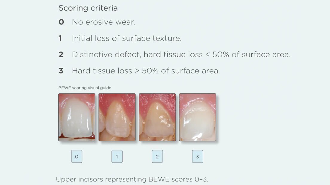 DIAGNOSING ENAMEL EROSION IN THE CLINIC