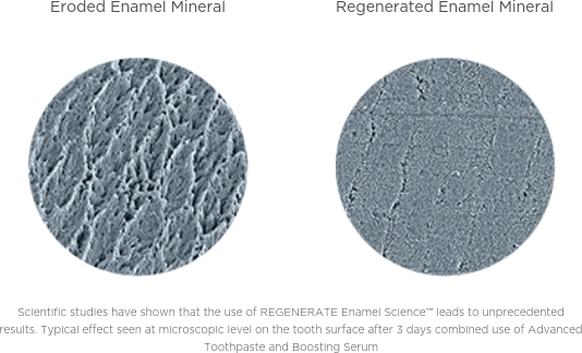 What is enamel erosion?