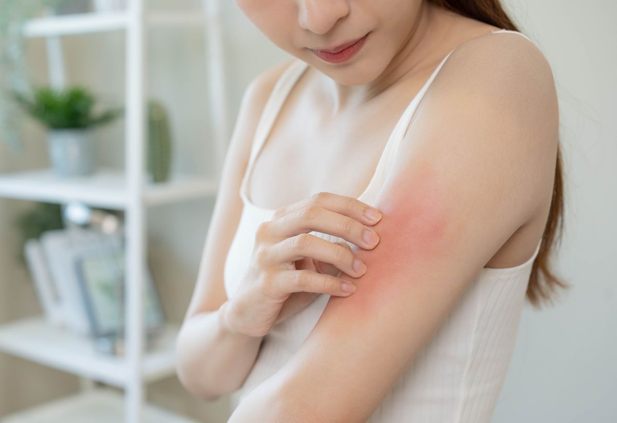 Asian woman scratching red mark on her arm, impaired skin barrier 