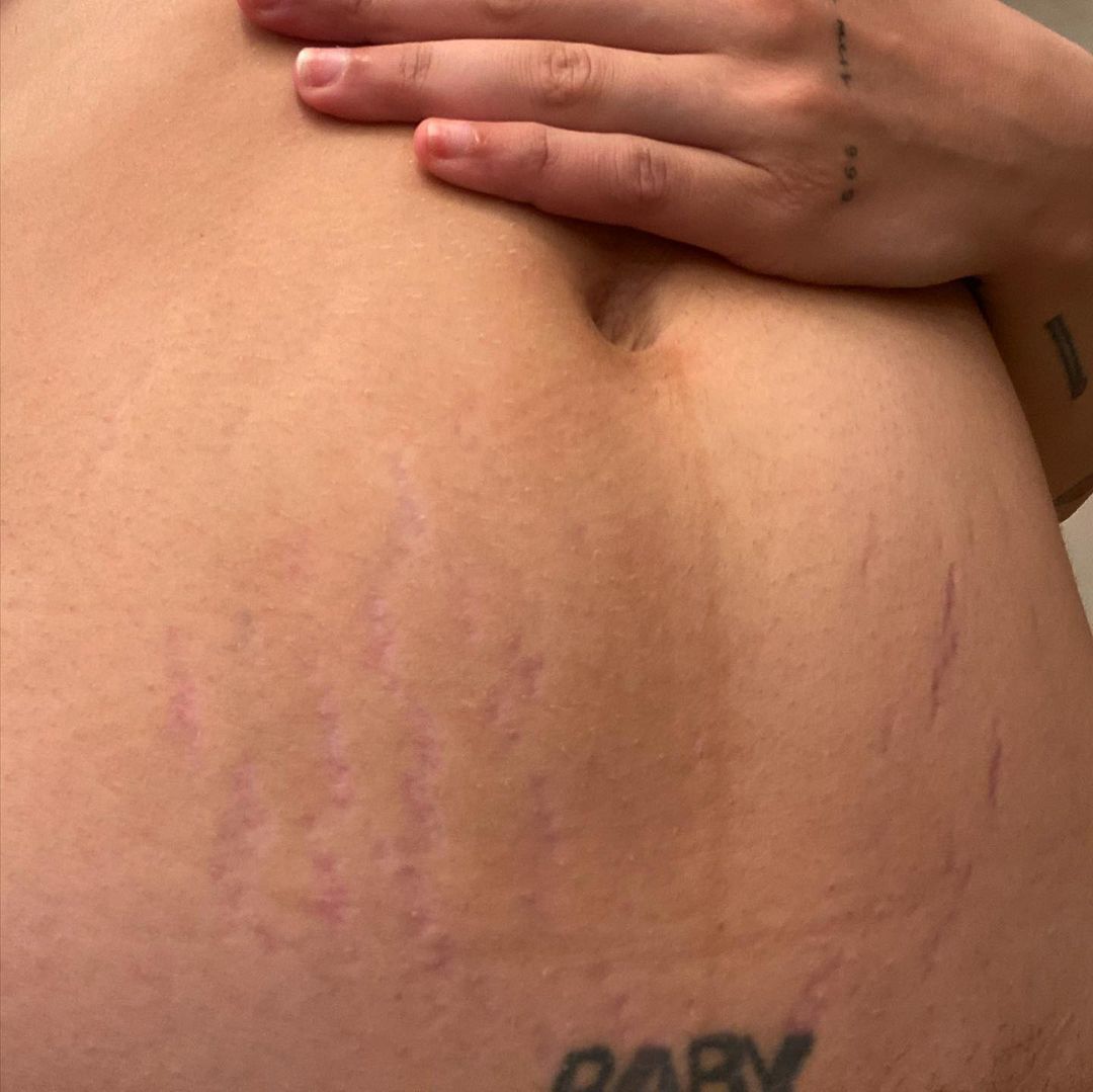 Closeup of stretch marks on belly