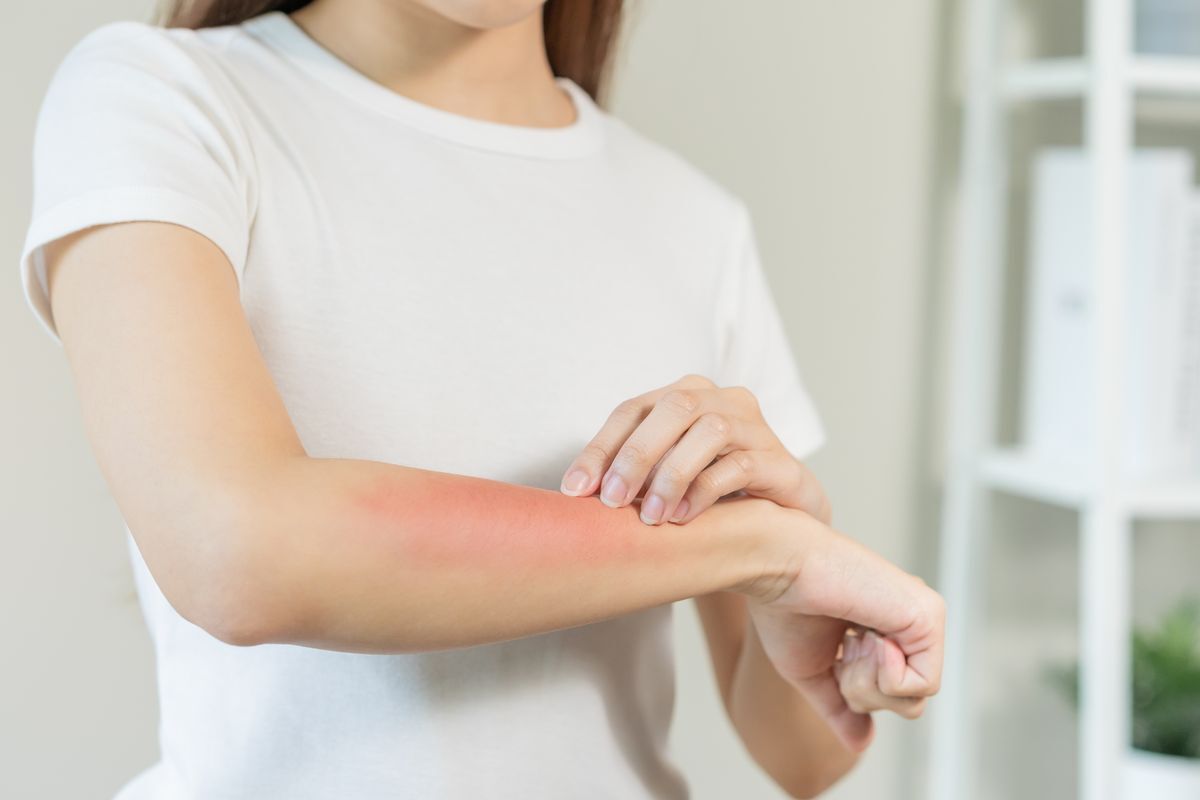 Closeup of a woman touching her forearm with redness. 