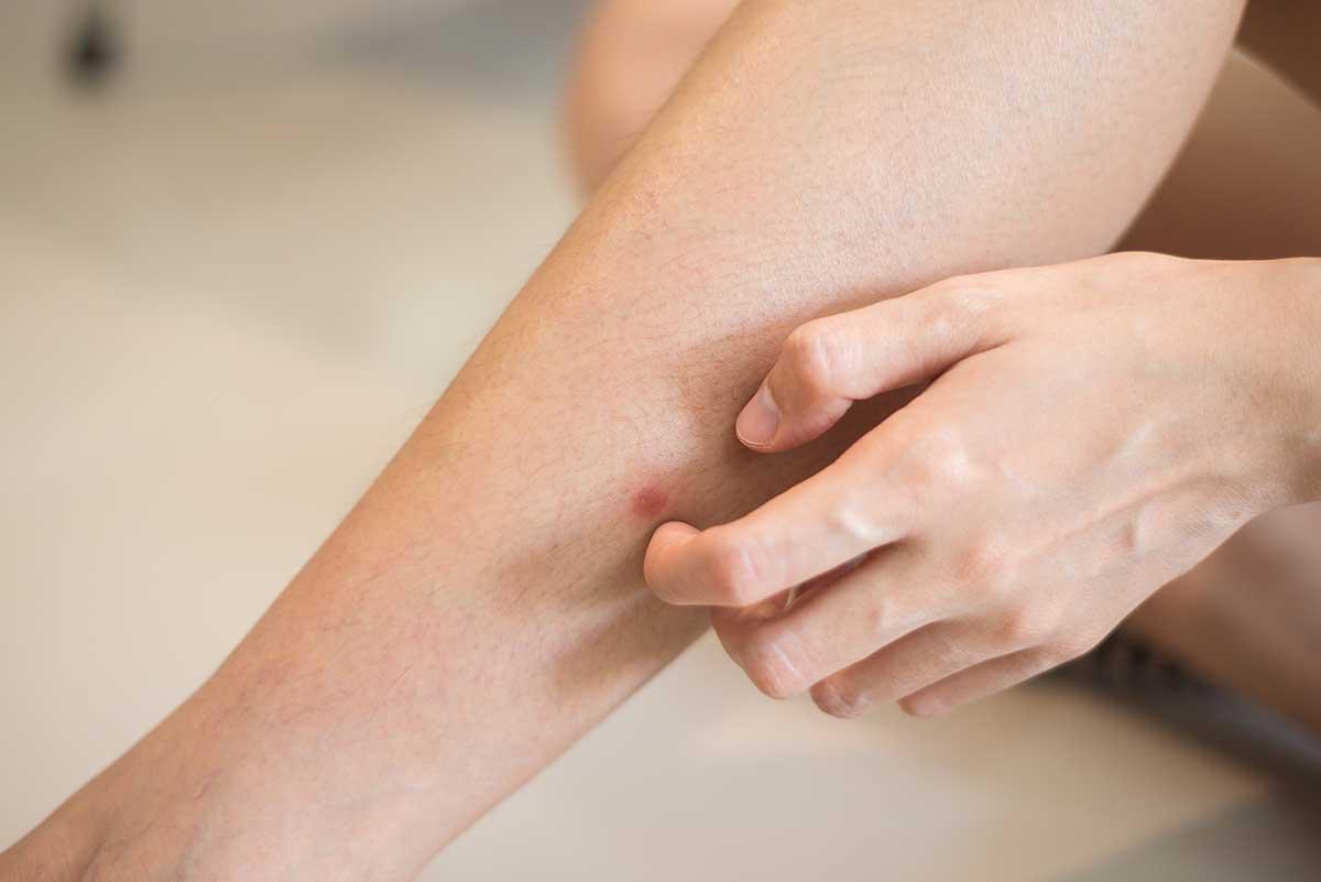 Woman scratching insect bite on leg