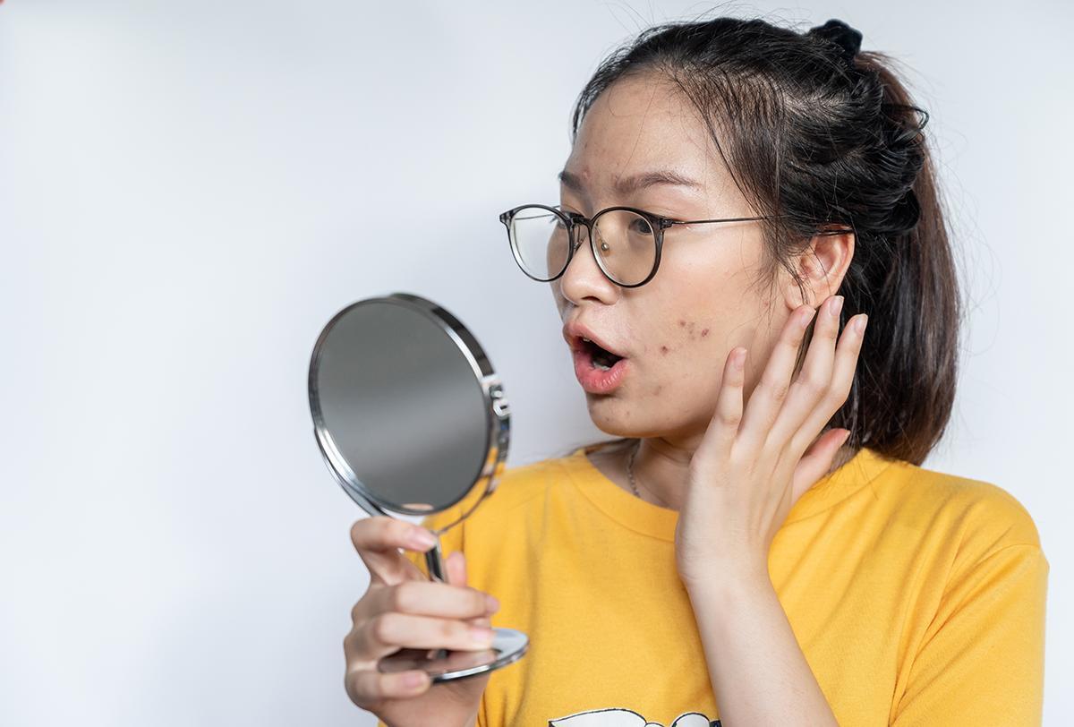 Asian woman with acne scars looking into a mirror