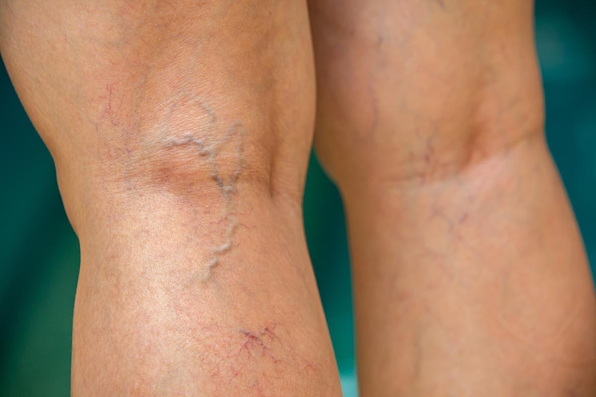 Closeup of varicose veins behind the knee