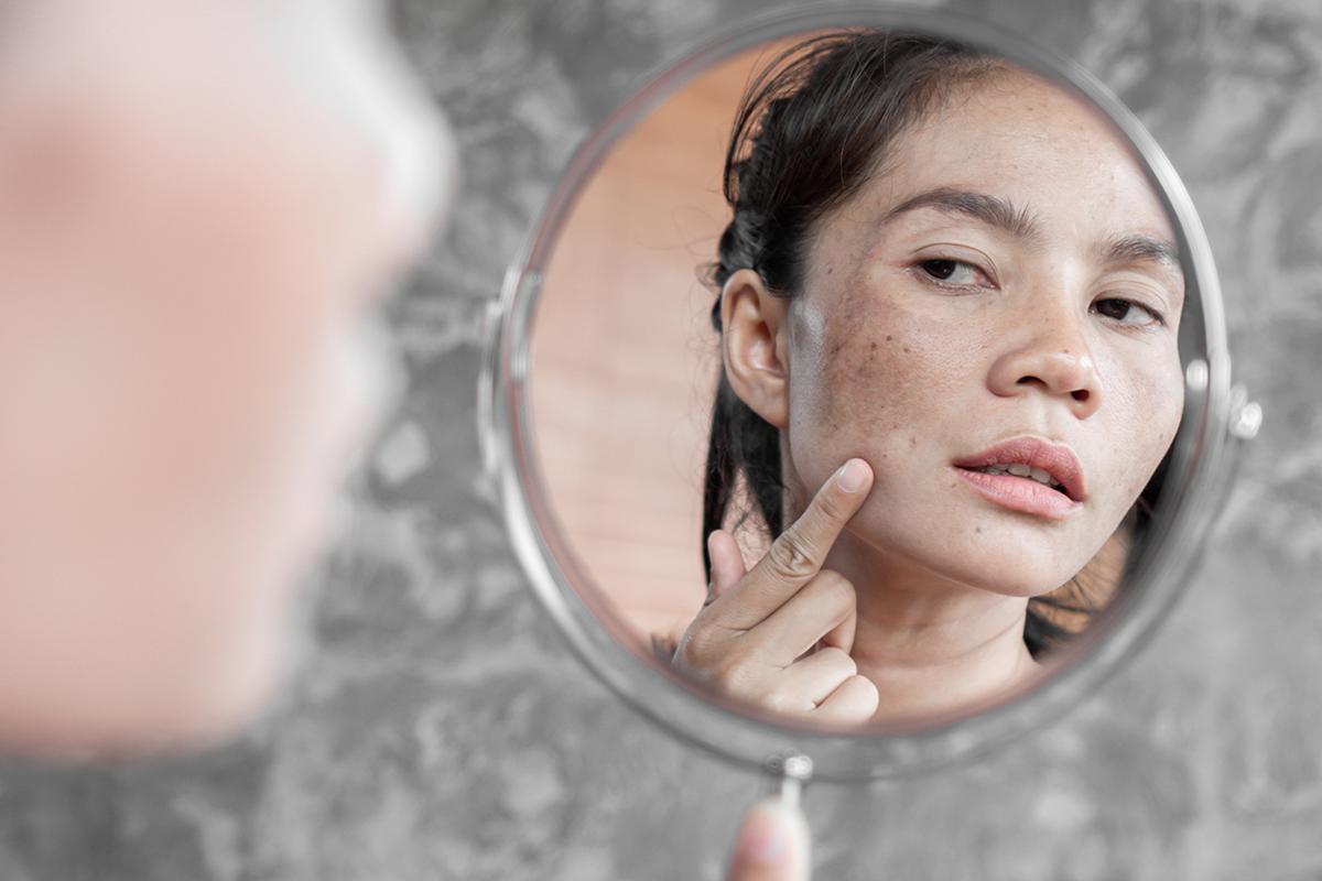 Asian woman with a skin condition looking in a mirror 