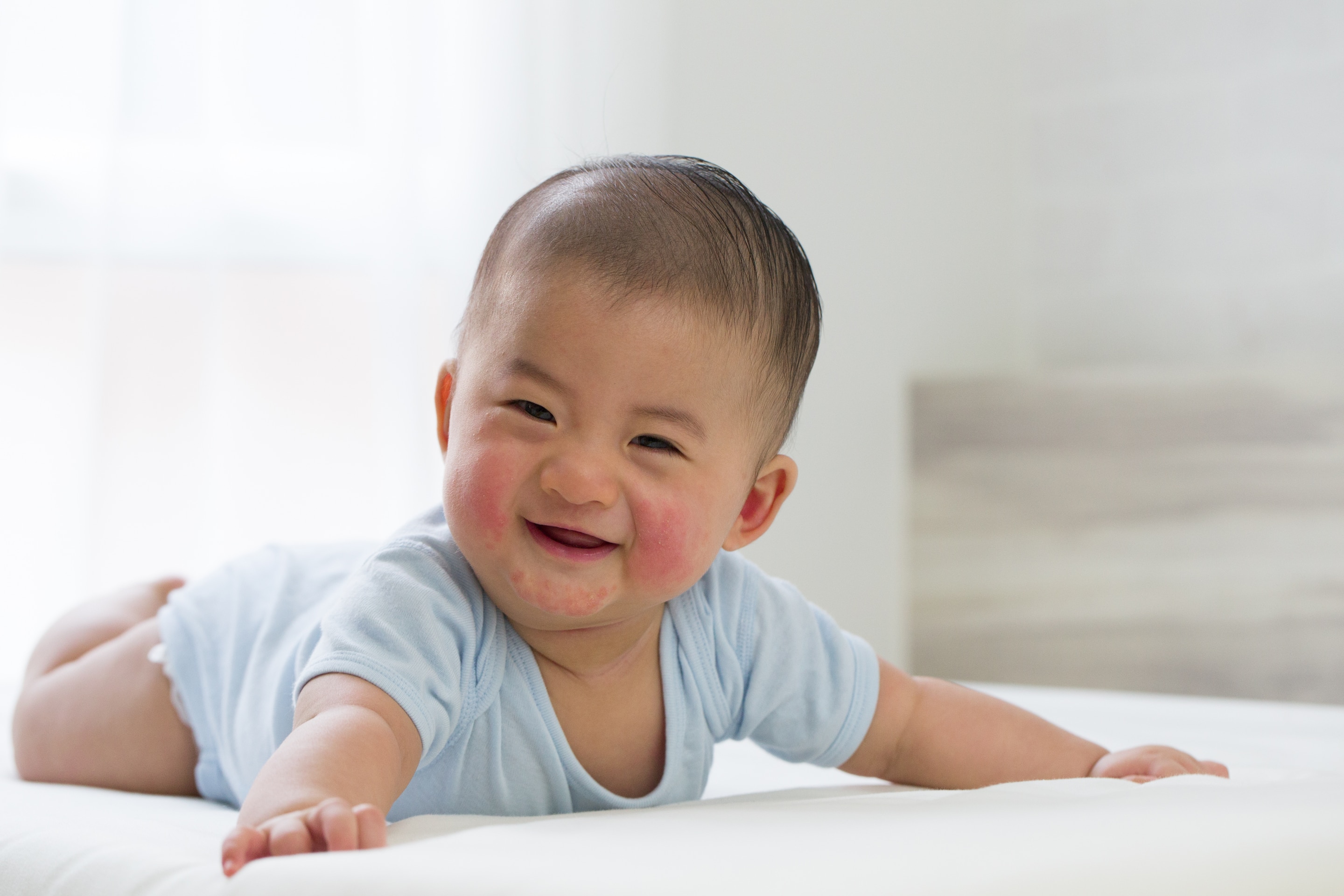 bayi asia yang sedang tersenyum dengan ruam kemerahan akibat alergi di area pipi