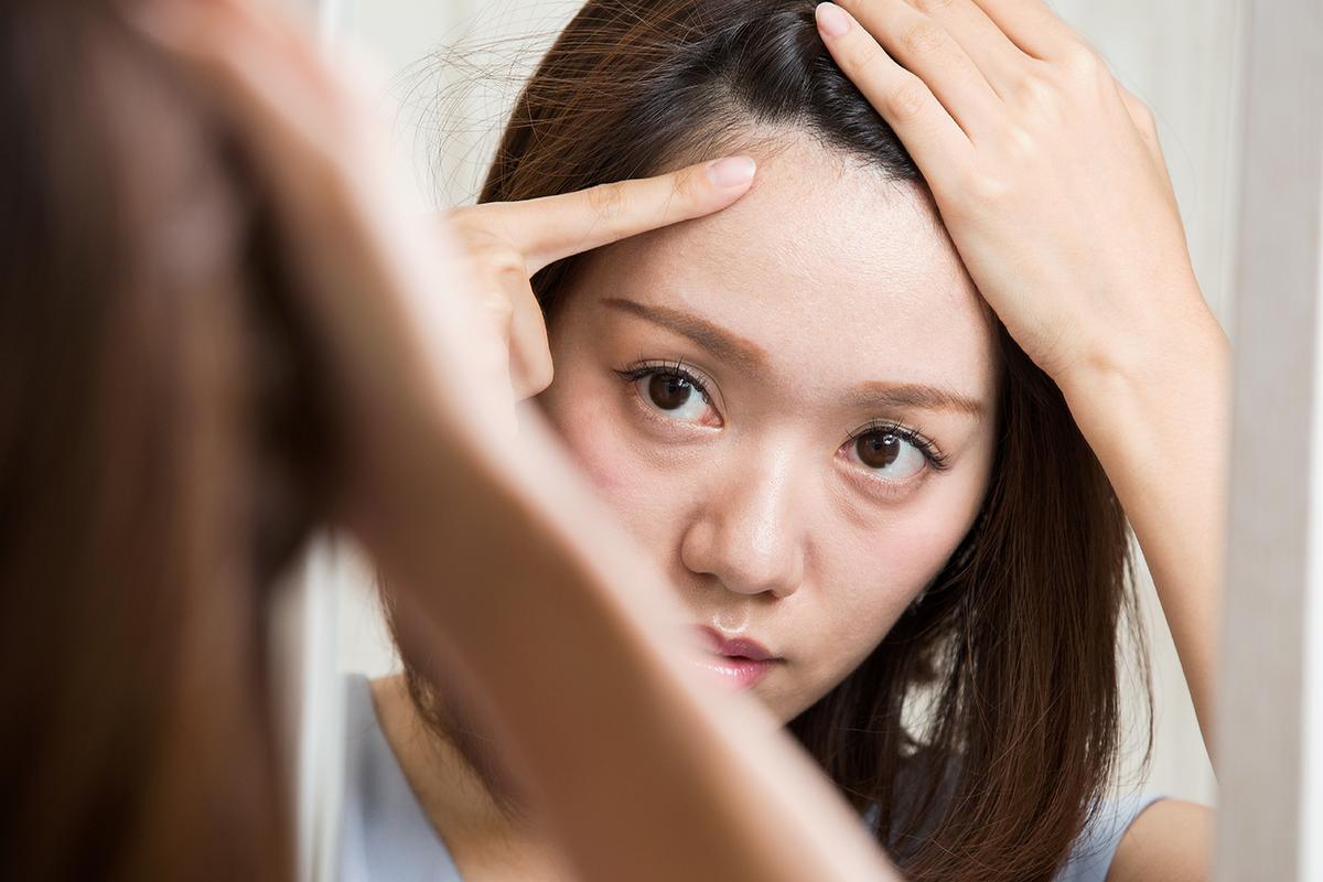 Scalp Acne: Prevention and Treatment