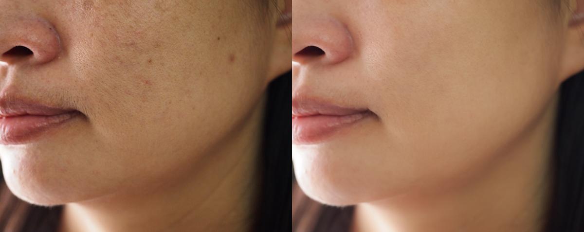 Before and after photo of woman with dark spots