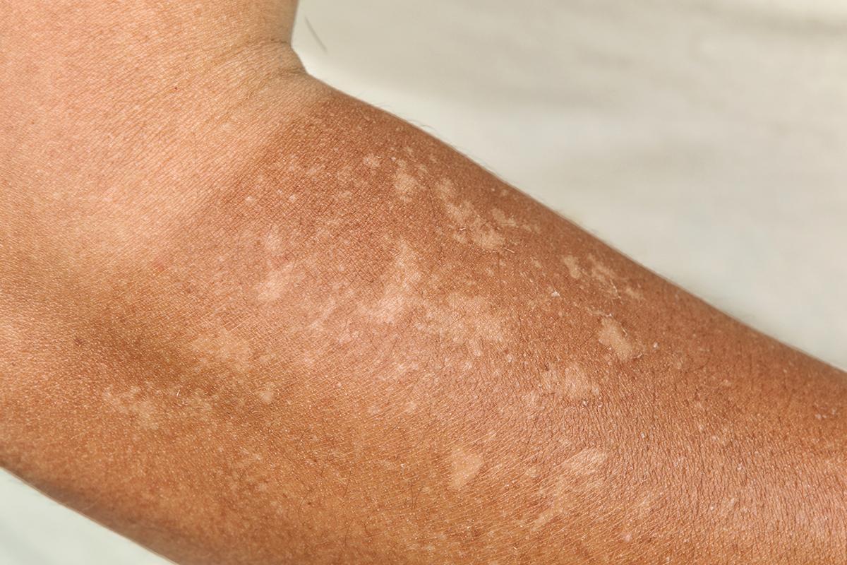 Closeup of sun damaged skin 