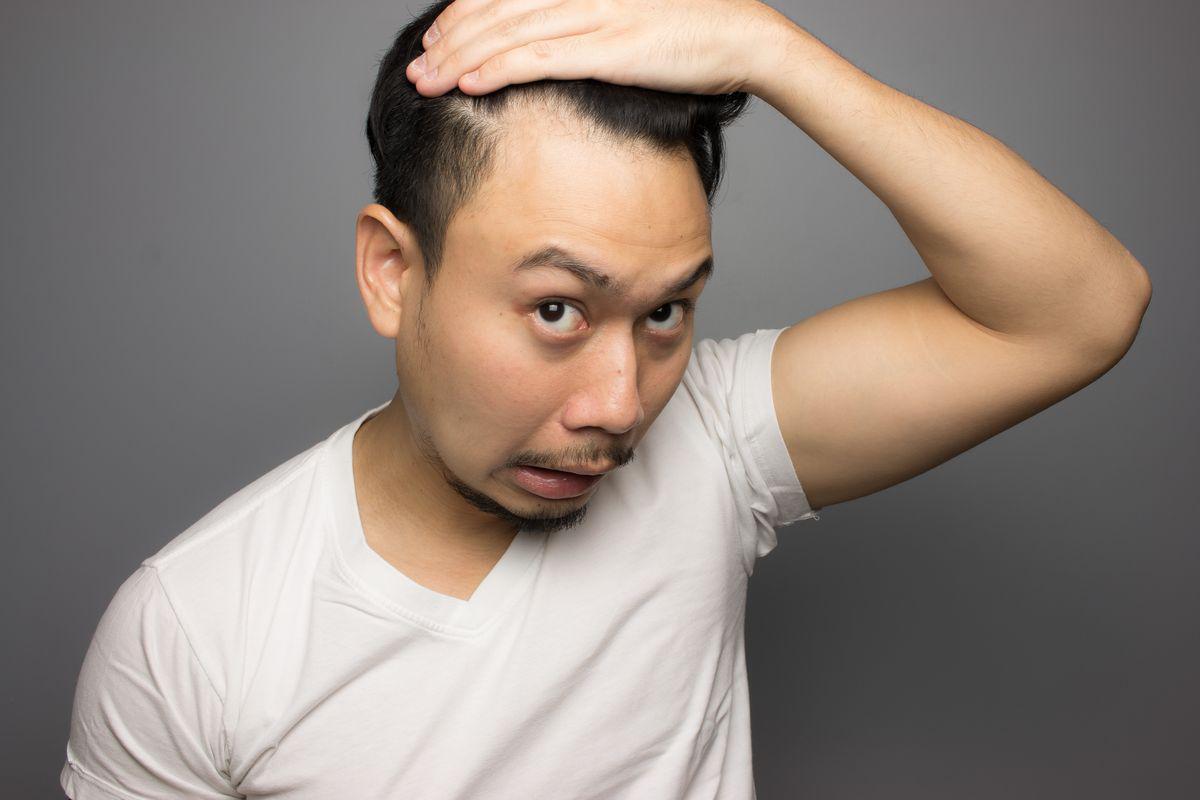 Asian man showing his scalp 