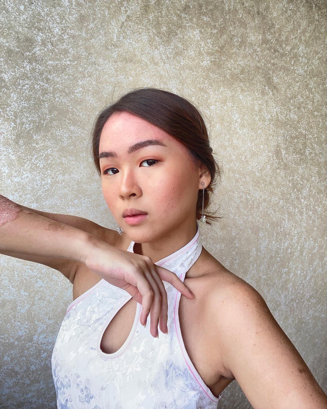 https://www.instagram.com/p/CLL_1Wzhfey/?utm_source=ig_web_copy_link   Image caption 5: Psoriasis warrior and beauty enthusiast, Chiara Lionel, shows that she loves her skin. (Credit: instagram/chichilionel) 