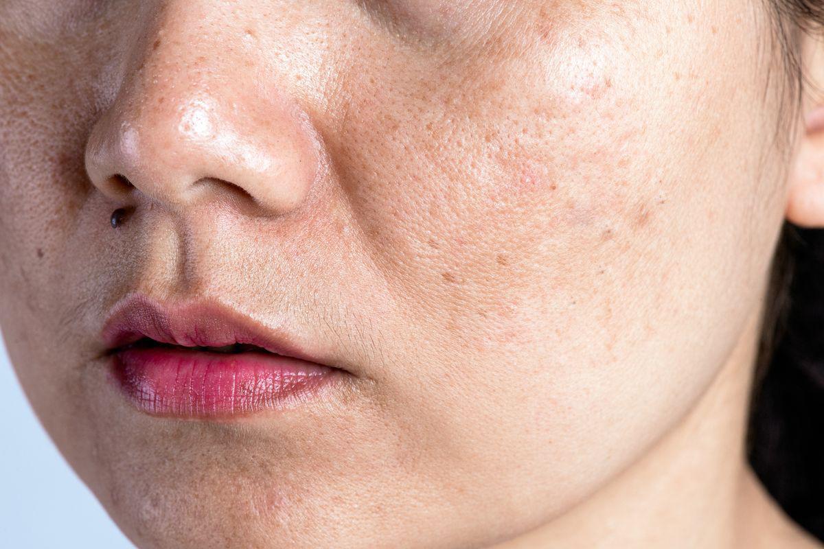 Woman with acne and dark spot