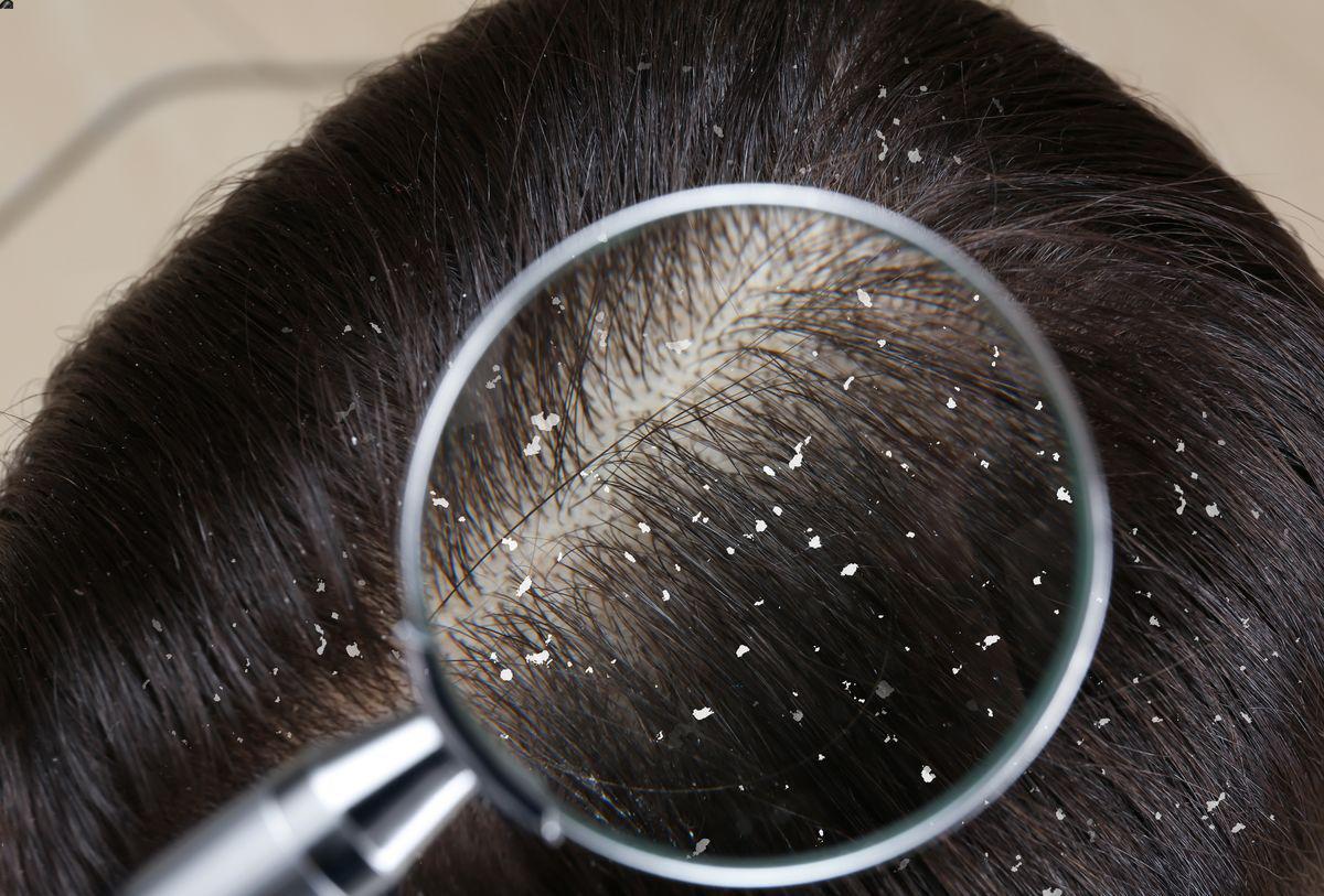 Closeup of dandruff on a woman’s scalp 